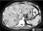 Liver metastases